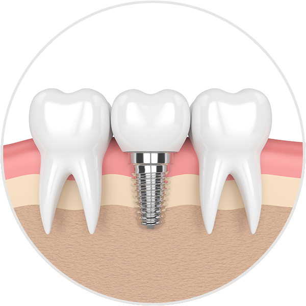 dental-implant-illust-circle