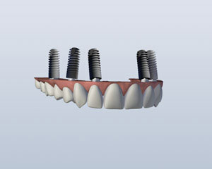 implant-retained-upper-denture