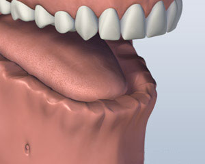 lower-jaw-all-teeth-missing-before-bar-attachment-denture
