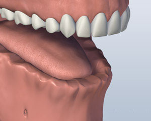 lower-jaw-all-teeth-missing-before-screw-attachment-denture