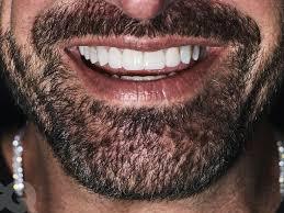 teeth veneers